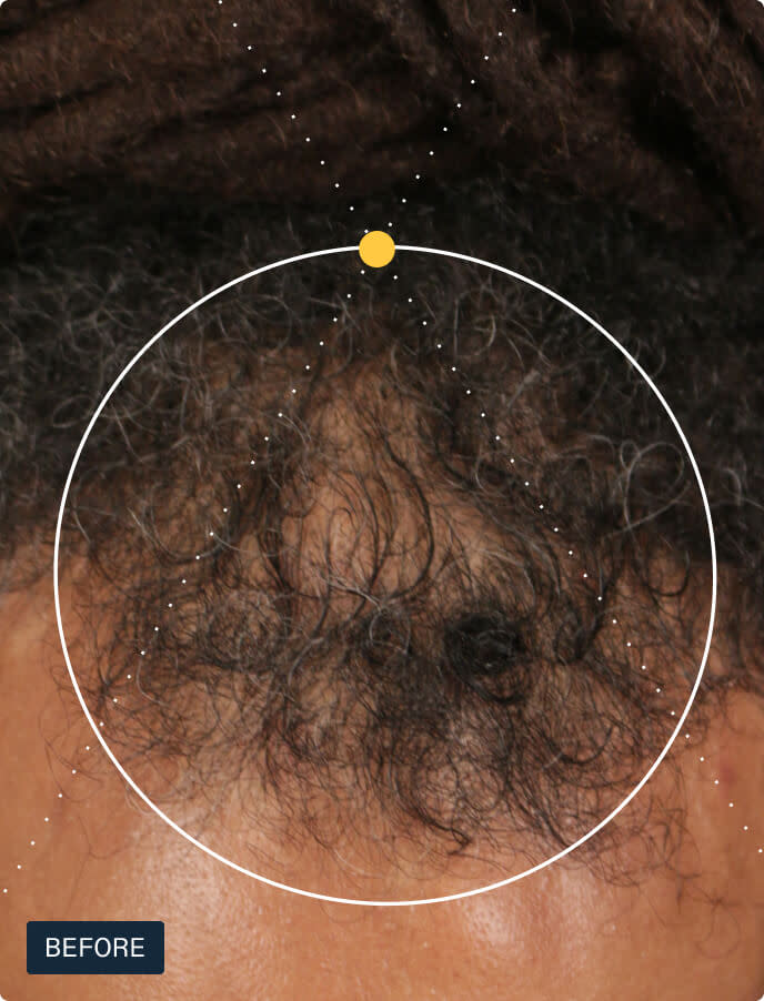Nutrafol Men's Hair Growth Supplements, Clinically Tested for Visibly Thicker Hair and Scalp Coverage, Dermatologist Recommended